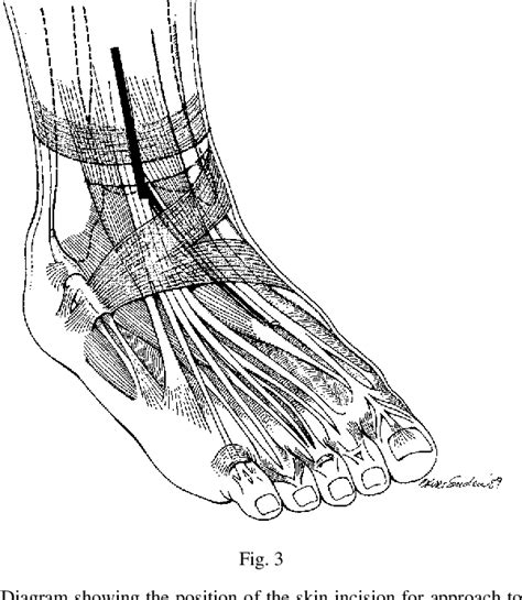 Figure 3 From Extensor Retinaculum Syndrome Of The Ankle After Injury
