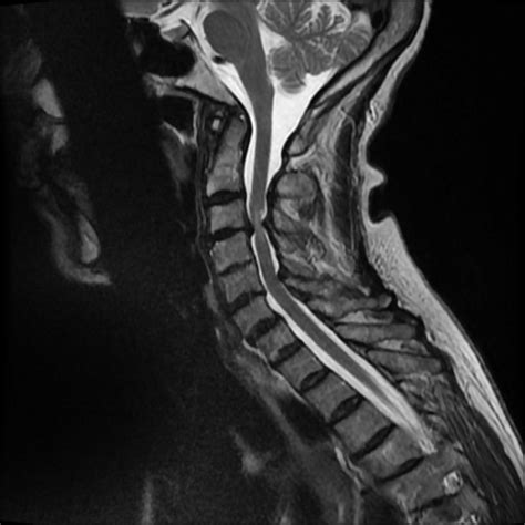 Sagittal Mri Of Cervical Spine Download Scientific Diagram