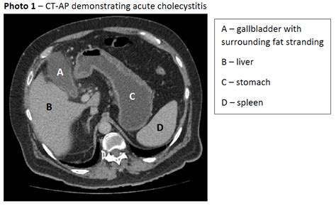 Percutaneous Cholecystostomy For Management Of Acute Acalculous