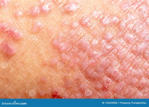 Atopic Dermatitis Ad Also Known As Atopic Eczema Is A Type Of 514