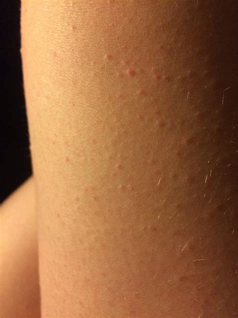 I Have Tiny Bumps Ingrown Hairs On My Leg How Do I Get Rid Of Them I