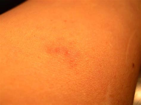 Bed Bug Bite Symptoms — Bed Bug Mutts