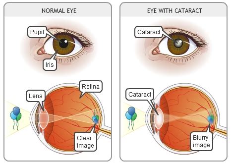 This article outlines the two different types of cataract surgery available. Cataracts St. Louis