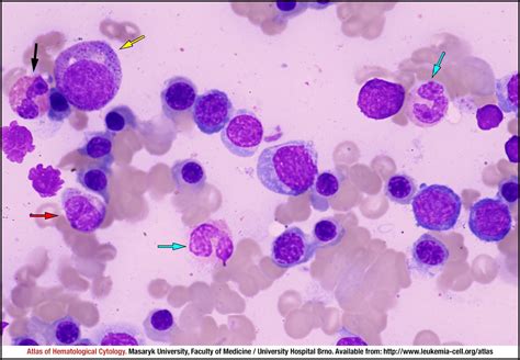 Autoimmune Haemolytic Anaemia With Cold Antibodies Cell Atlas Of