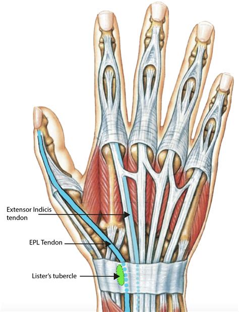 Rupture Of The Extensor Pollicis Longus Epl Tendon Fife Virtual Hand Clinic