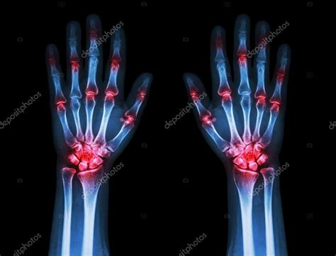 Rheumatoid Arthritis Knuckles Arthritis Of The Hand Symptoms Types
