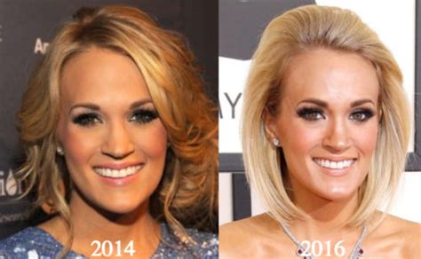 Carrie Underwood Plastic Surgery Before And After Photos Latest