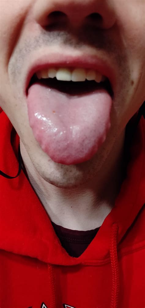 I Just Learned That This Is Called Scalloped Tongue And It Doesn T Happen To Everyone Another