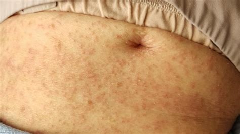 Kindred Living Aged Care Allegations Of A Scabies Outbreak At Whyalla