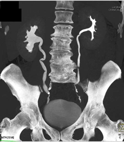 Right Hydronephrosis Due To A Stone In The Distal Right Ureter Kidney