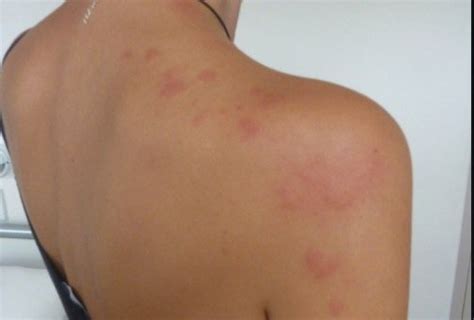 Bed Bug Rash Symptoms And Appearence 5 Treatment Methods With Photos
