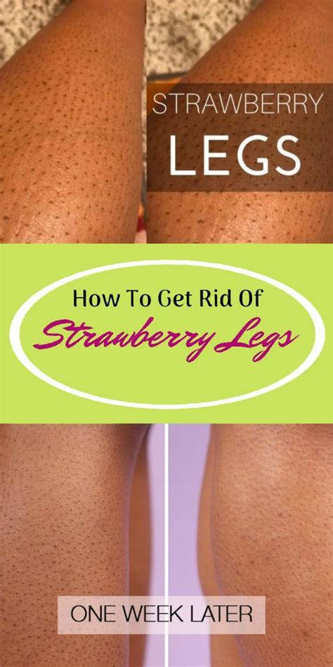 It's makes sure skin is kept moist and soft, as well as helping your skin's natural protective barrier. How to Get Rid of Strawberry Legs fast at home # ...