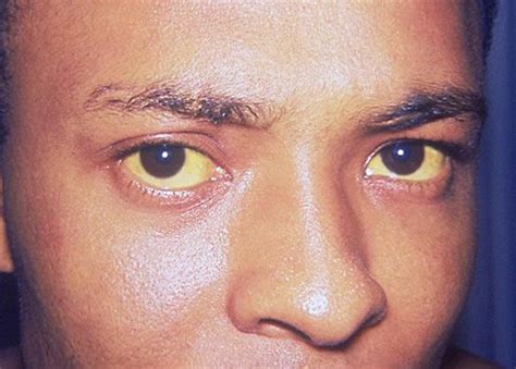 Jaundice Description Symptoms Causes And Treatment Britannica