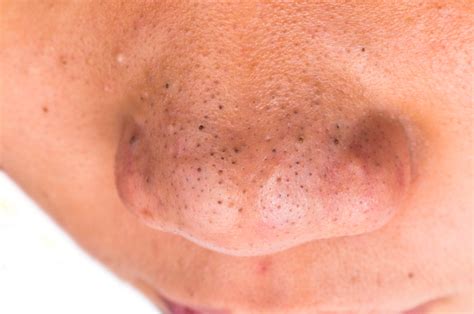 3 Best Blackhead Treatments