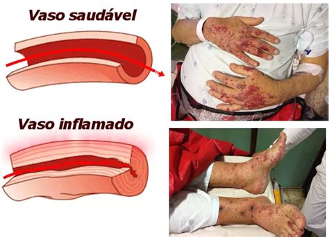 Dicas De Enfermagem Vasculite