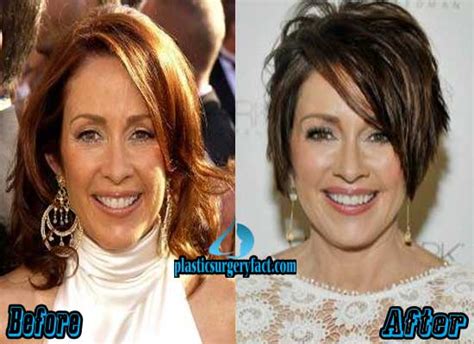 Patricia Heaton Plastic Surgery Before And After