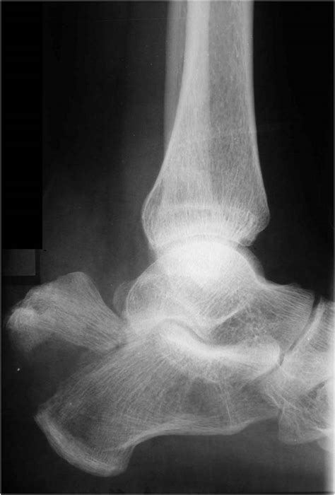 Avulsion Fracture Of The Calcaneal Tuberosity A Soft Tissue