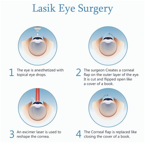Procedure Laser Eye Surgery Lasik