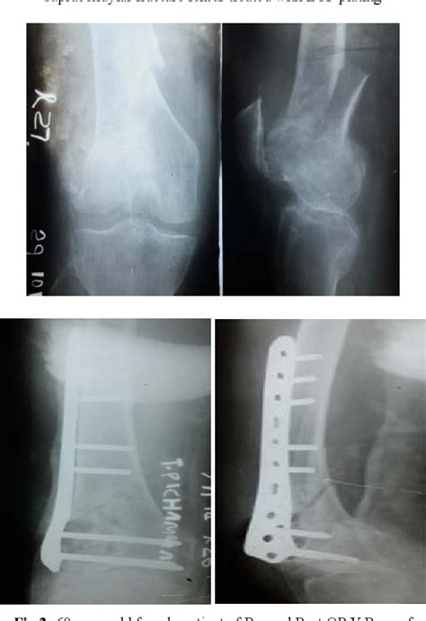 Figure 2 From Surgical Management Of Fracture Of Distal End Of Femur In