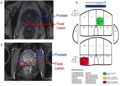 Template Prostate Biopsy