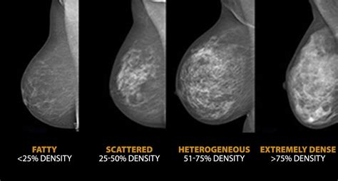 Breast Density Does It Really Matter Life Among Women