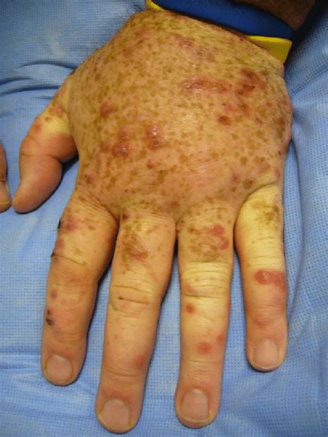 Sweet Syndrome Erythematous And Edematous Papules And Plaques Were