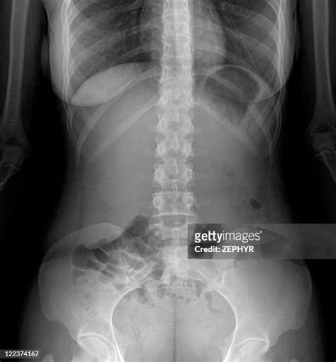 Stomach Xray Photos And Premium High Res Pictures Getty Images