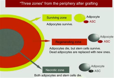 9 Conclusive Schema For Three Zones Of The Grafts The Most Superficial