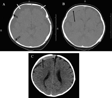Showing Hygroma Chronic Subdural Hematoma Evolving Into A Large Rebleed