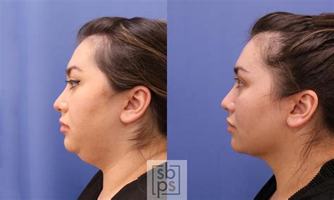 Chin Liposuction Before And After Pictures Case 472 Torrance Ca