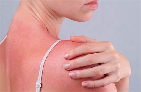 Sun Poisoning Causes Symptoms And Treatments Usa Health Articles