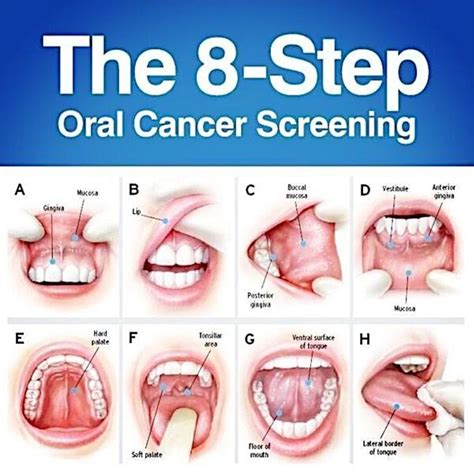 Early Stage Mouth Cancer Images Cancer News Update
