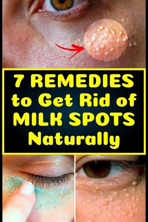These 7 Remedies Can Remove The Milia Milk Spots From Your Face