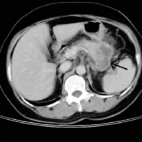 Figure Computed Tomography Shows Pancreatic Tail Tumor With Regional