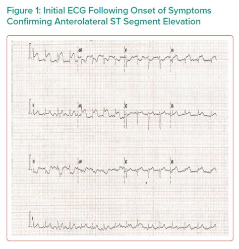 Initial Ecg Following Onset Of Symptoms Confirming Anterolateral St