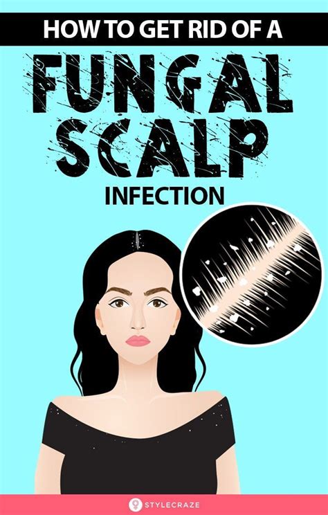 How To Get Rid Of Fungal Scalp Infection 8 Natural Remedies Homemade