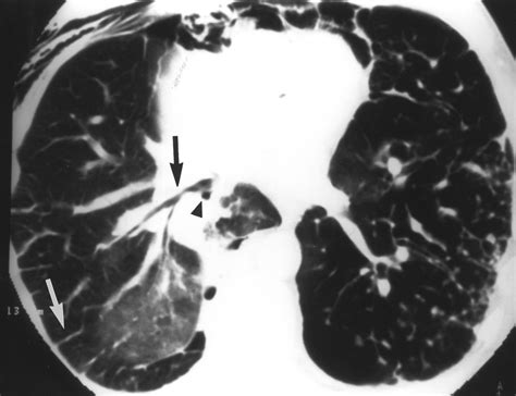 Lung Torsion After Lung Transplantation Evaluation With Helical Ct Ajr