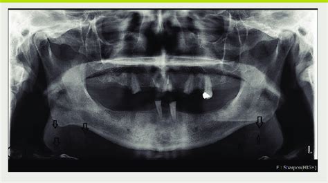 Case One Panoramic Radiograph Showing Railroad Track Radiopacities