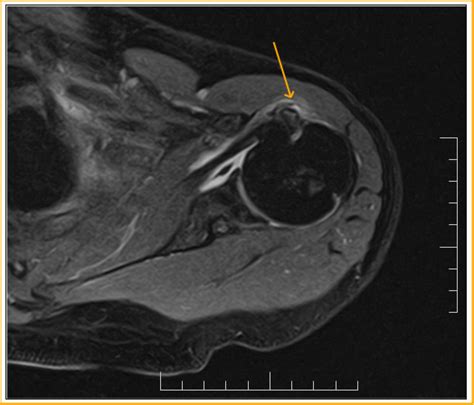 Long Head Biceps Tear Mri Sumer S Radiology Blog