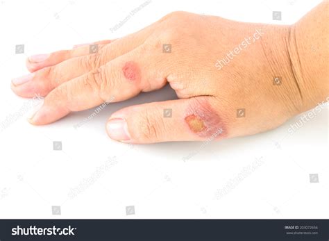 Hand Teenager Blisters Due Burns Stock Photo 203072656 Shutterstock