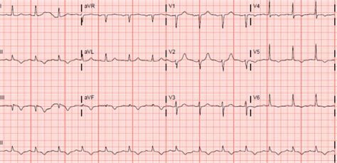 Electrocardiogram Showing Sinus Rhythm Normal Axis Q Waves In Lead 3