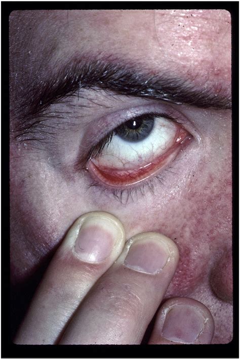 Ocular Rosacea Psoriasis And Lichen Planus Clinics In Dermatology