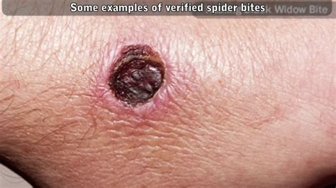 Worst Spider Bite Ever Brown Recluse Wandering Spider Tarantula
