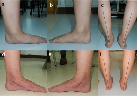 A 12 Year Old Boy With Bilateral Flexible Flatfoot Deformity Who
