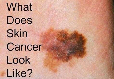 Ahead, you'll find everything you need to know about melanoma, how to identify it, and what to do if. Do You Know What Skin Cancer Looks Like? - Bath and Body