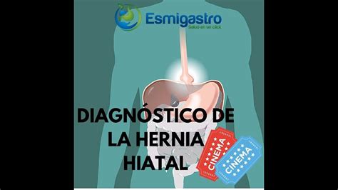 Diagnóstico De La Hernia Hiatal Youtube