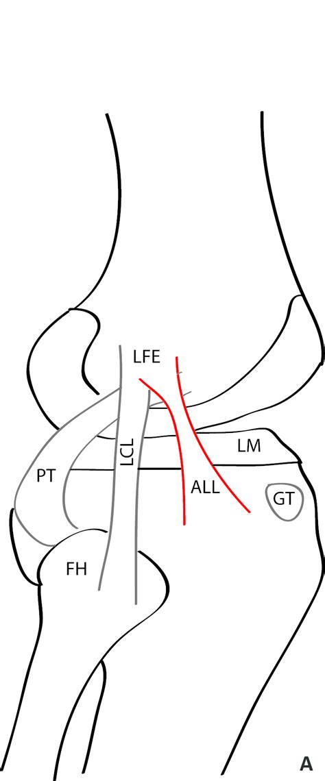 The Classic Anatomy Of The Anterolateral Ligament And Its Relationships
