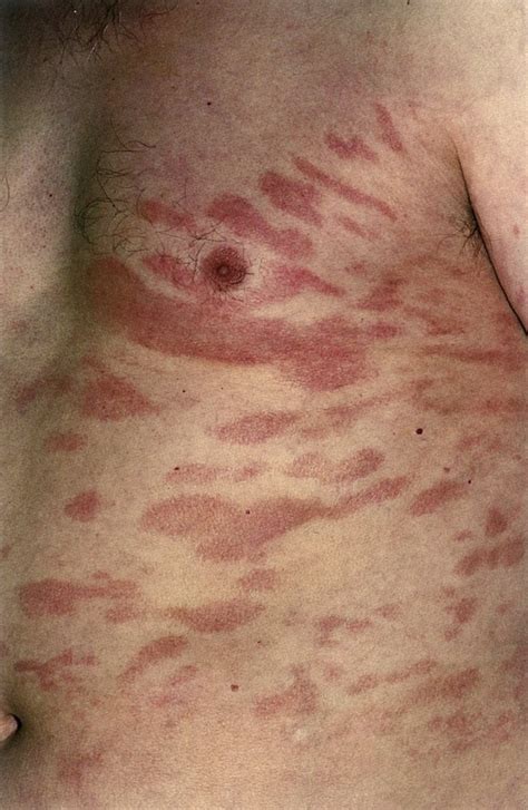 Lymphoma Rash Armpit Rash Lymphoma Skin Rashes Are Uncommon