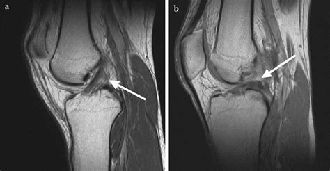 Mri Scan Knee Ligament Damage