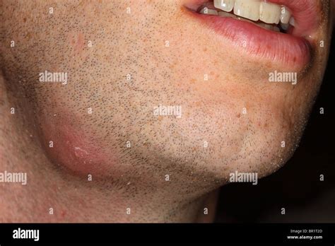 Boil Or Abscess Of The Face Stock Photo Alamy